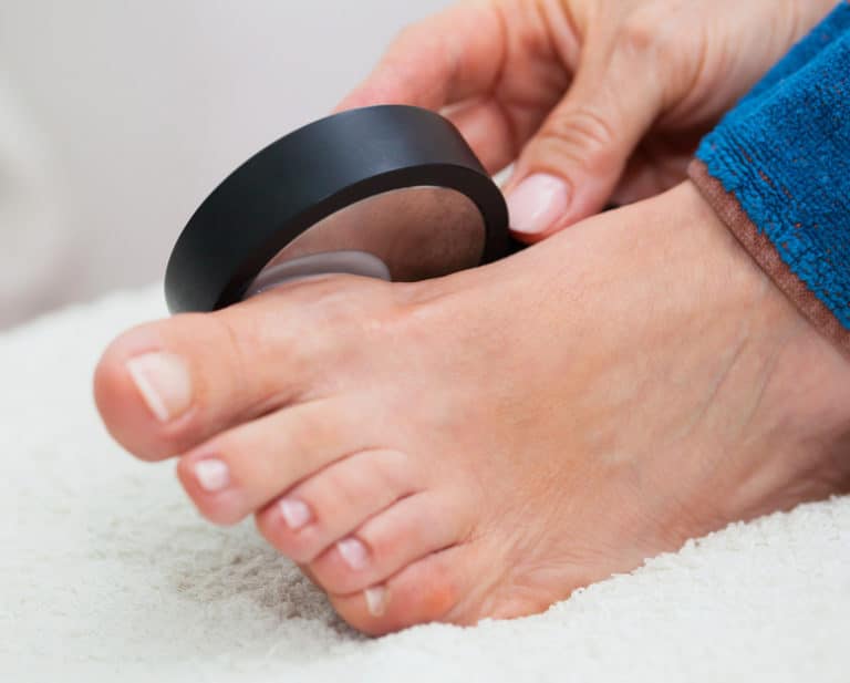 Hallux valgus : comment se passe l’opération ?