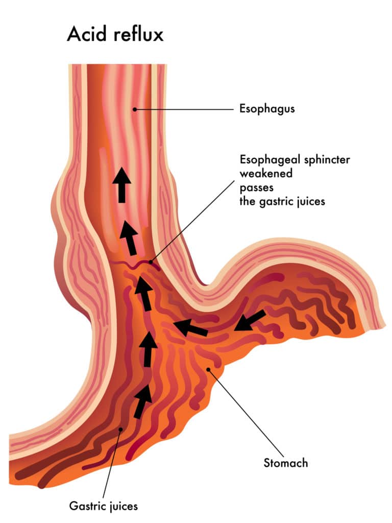 Qu'est-ce que le reflux gastro-œsophagien ? A quoi est-il dû ?